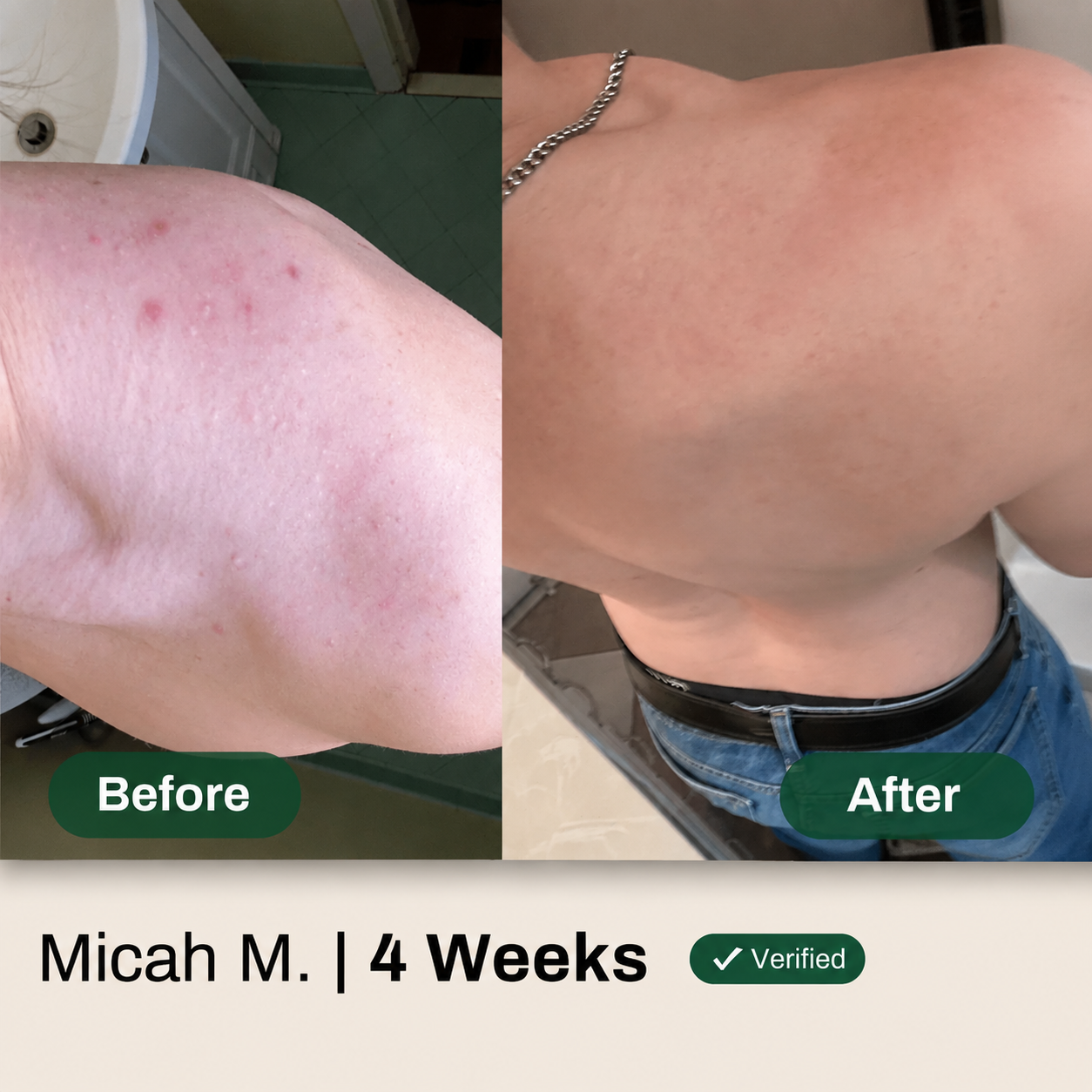 Miracle Body Acne Cleanser - AHA BHA PHA
