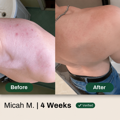 Miracle Body Acne Cleanser - AHA BHA PHA